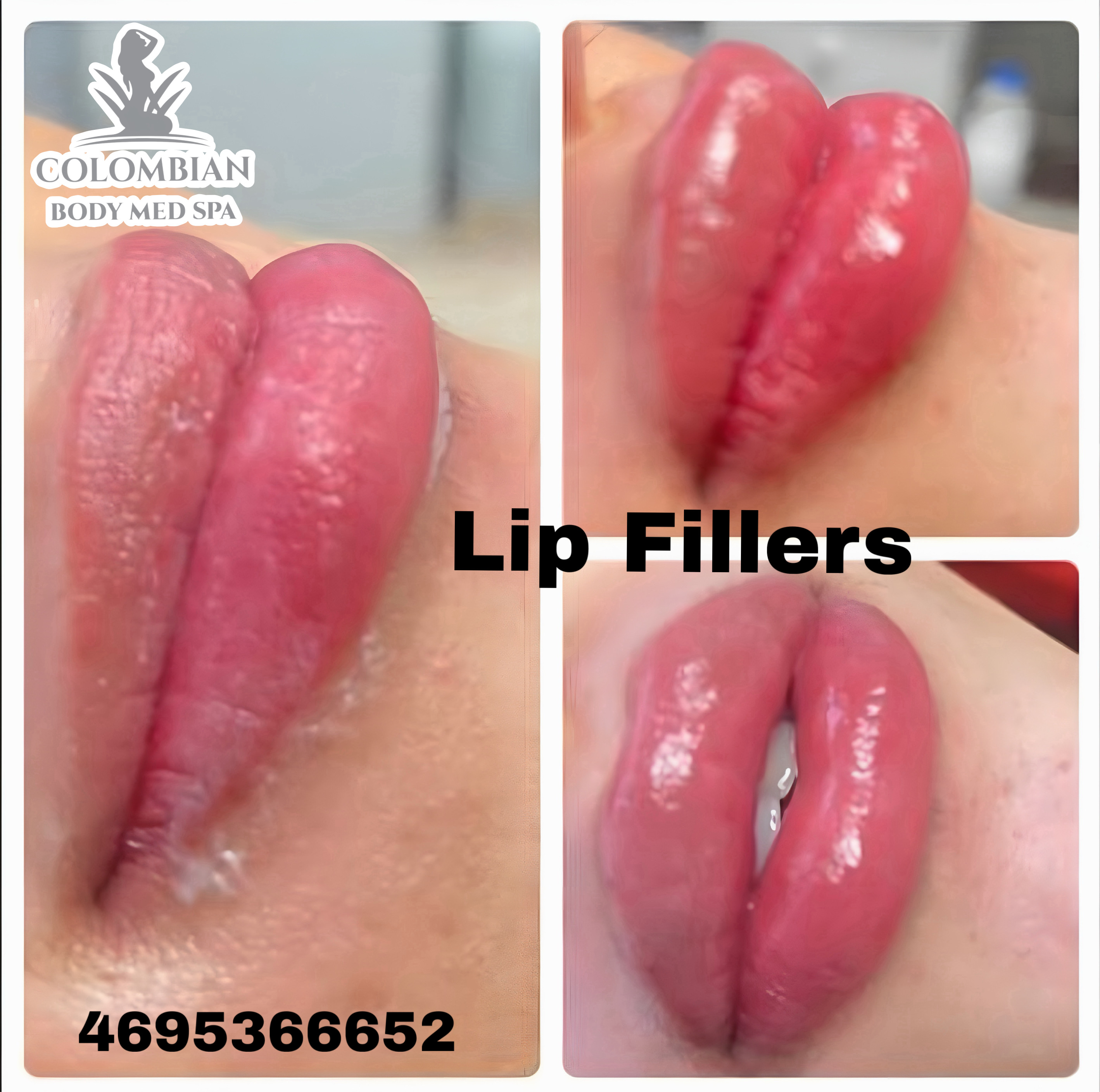 Lip Fillers - Results